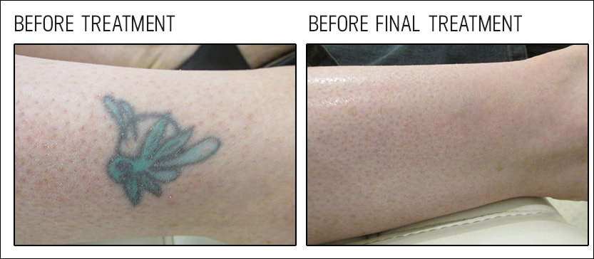 Tattoo Removal After Care | On Second Thought | Northern Ireland | Belfast  | Newtownabbey - On Second Thought